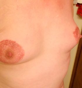 Trans breasts growth